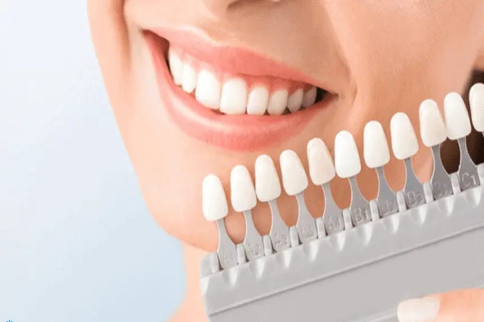Veneers In Turkey - Definition, Types, Cost And More